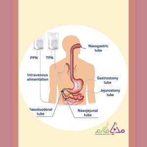 Medication Administration via Enteral Tubes دوره ی آموزشی گاواژ دارو ها