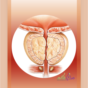 Benign Prostatic Hyperplasia (BPH) بزرگی خوش خیم پروستات (BPH)