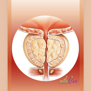 Benign Prostatic Hyperplasia (BPH) بزرگی خوش خیم پروستات (BPH)