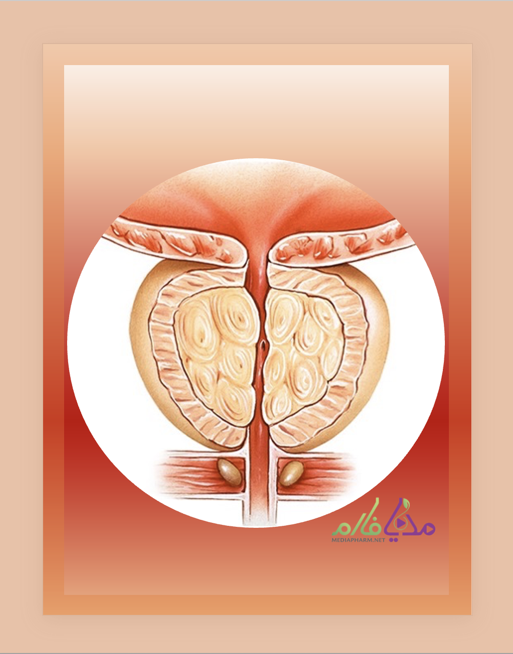 Benign Prostatic Hyperplasia (BPH) بزرگی خوش خیم پروستات (BPH)